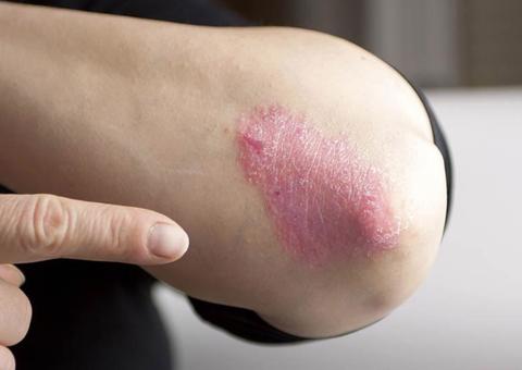 Dia mundial da Psoríase: especialista alerta que doença não é contagiosa