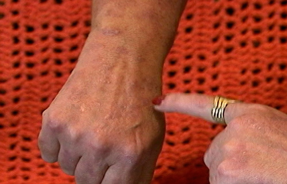 Psoríase atinge 2% da população e pode causar problemas no coração