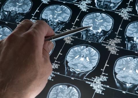 Pesquisadores conseguem combater sintomas do Alzheimer com canabinoide