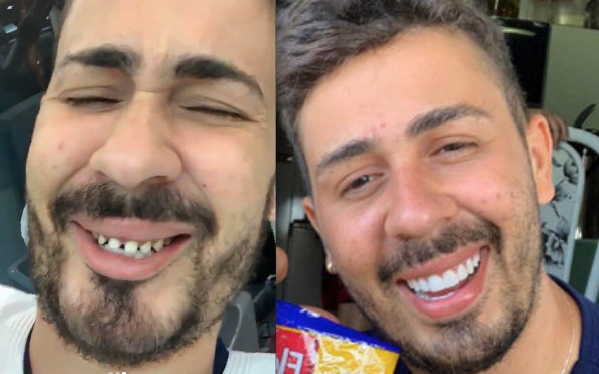 Carlinhos Maia choca ao mostrar dentes naturais durante manutenção de lentes