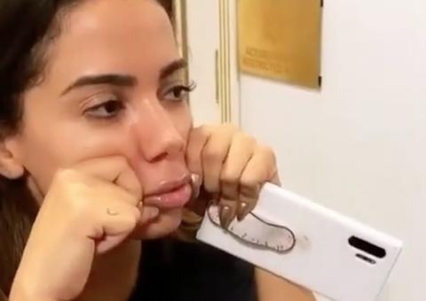 Anitta faz preenchimento labial para ficar igual a filtro do Instagram
