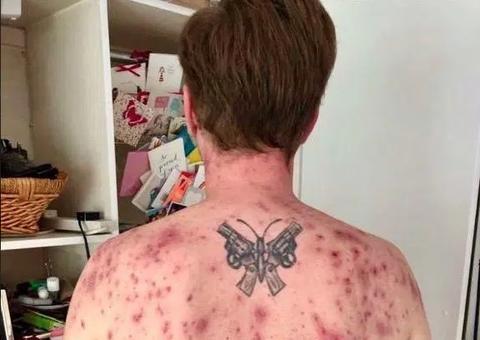 Homem quase morre após parasita depositar ovos em seu pênis 