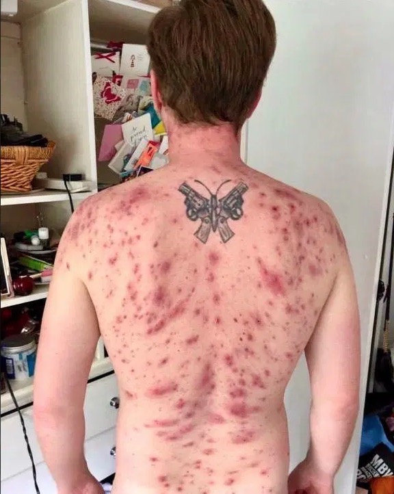 Homem quase morre após parasita depositar ovos em seu pênis 