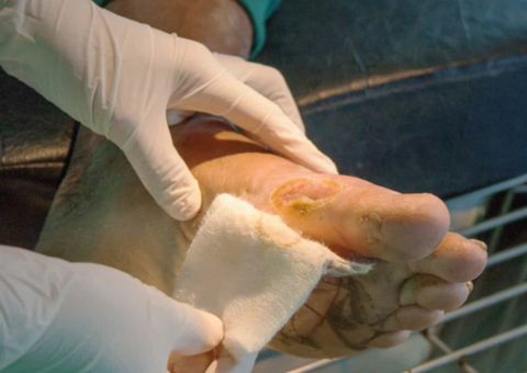 Cientistas fazem descoberta do novo tipo da bactéria "devoradora de pele"