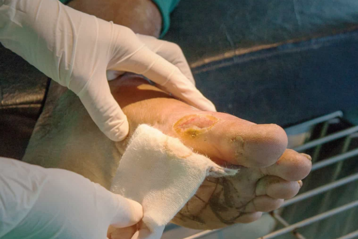 Cientistas fazem descoberta do novo tipo da bactéria "devoradora de pele"