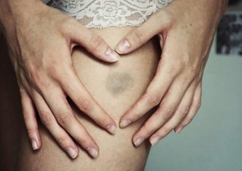 O que indicam manchas roxas mesmo quando não teve nenhuma pancada