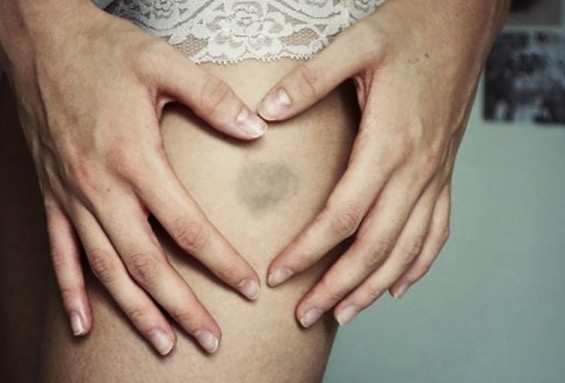 O que indicam manchas roxas mesmo quando não teve nenhuma pancada