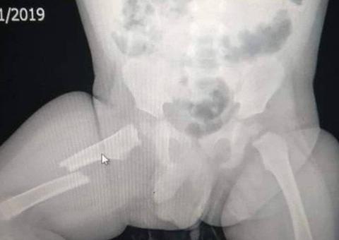 Homem fica com raiva de companheira e quebra perna de filho