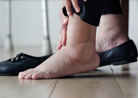 Surgimento de varizes nos pés requer atenção especial e tratamento com especialista