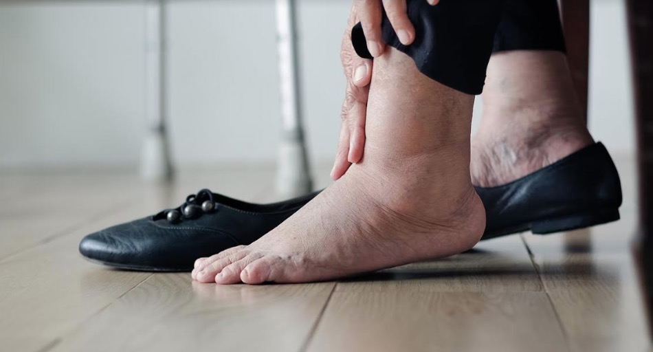 Surgimento de varizes nos pés requer atenção especial e tratamento com especialista