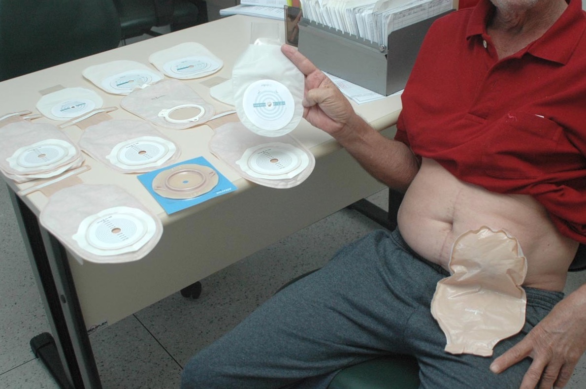 MPs ajuizam ação para garantir dignidade aos pacientes ostomizados do Amazonas 