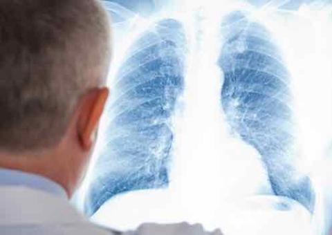 Brasil assume conselho de entidade que combate a tuberculose no mundo