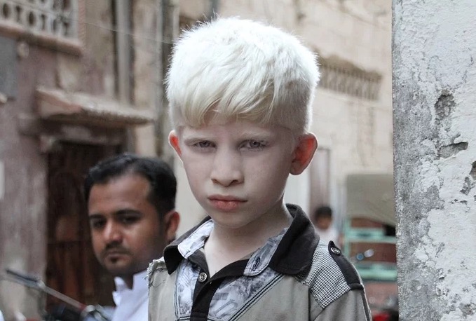SUS deverá fornecer protetor solar e óculos escuros a albinos