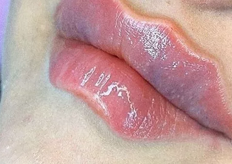 Novo procedimento estético 'Boca do Diabo’ vira febre mundial  