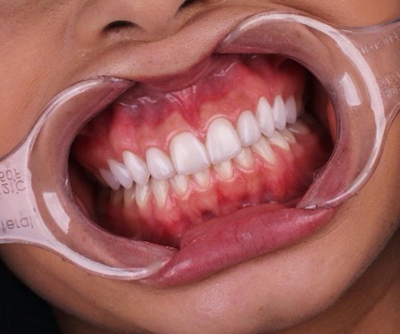 Saiba tudo sobre as famosas 'Lentes de Contato Dentais’