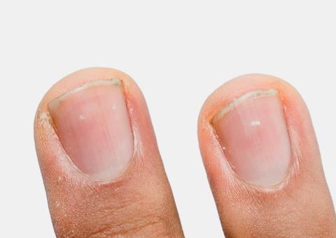Veja o que pode ser mancha branca na unha e como tratar