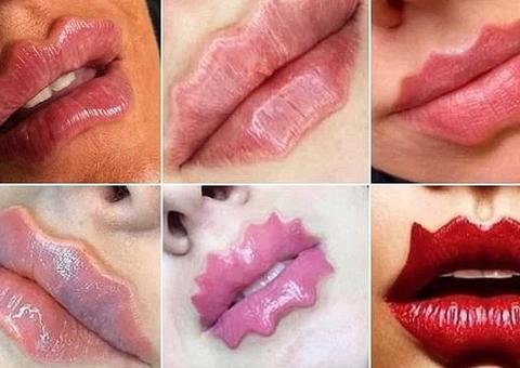 Lábios do Diabo: Cirurgião plástico faz alerta para nova tendência