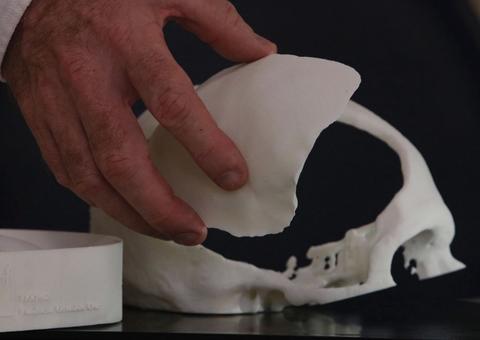 Brasileiros desenvolvem tecnologia de reconstrução craniana