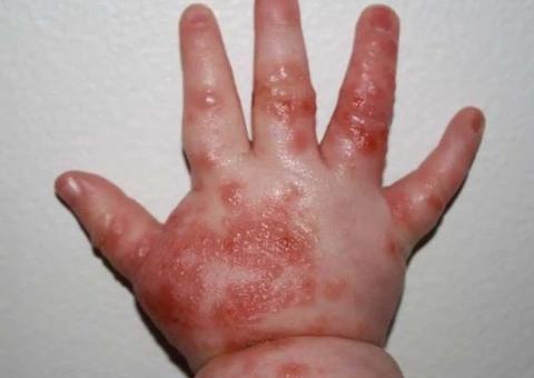 Pediatra alerta para os cuidados com a Síndrome mão-pé-boca nas crianças