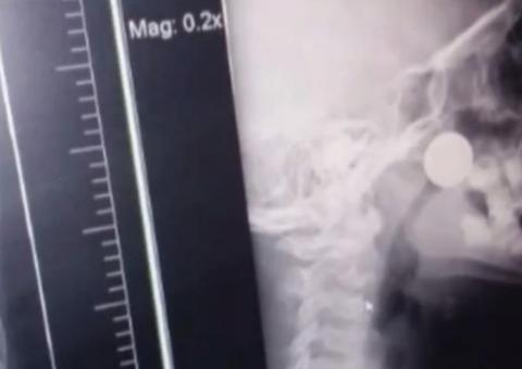 Menino fica dois dias com moeda presa dentro do nariz e retirada é feita após espirro