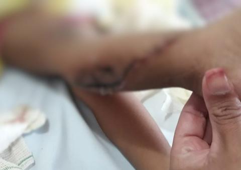 Criança de 3 anos sofre corte na perna em escada rolante de shopping