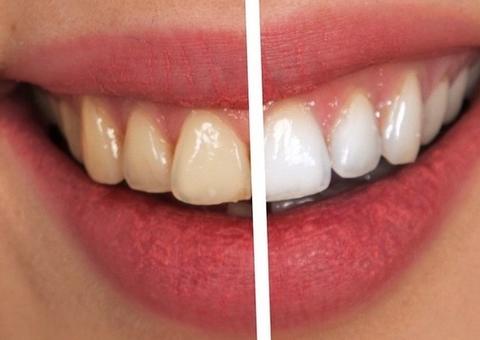 Veja alimentos que escurecem os dentes 