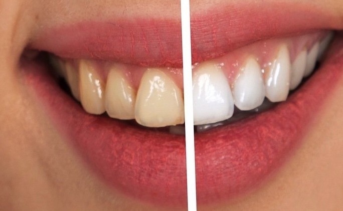 Veja alimentos que escurecem os dentes 