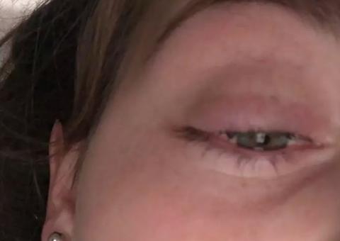 Jovem quase perde a visão ao fazer extensão de cílios 