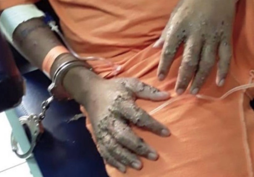 Após detentos terem corpos deformados por infecção, MP pede interdição de presídio