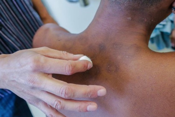 Hanseníase: conheça os sintomas e o tratamento para a doença