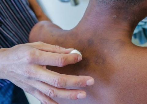 Hanseníase: conheça os sintomas e o tratamento para a doença