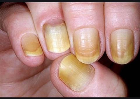 Veja o que fazer para clarear unhas amareladas pelo esmalte