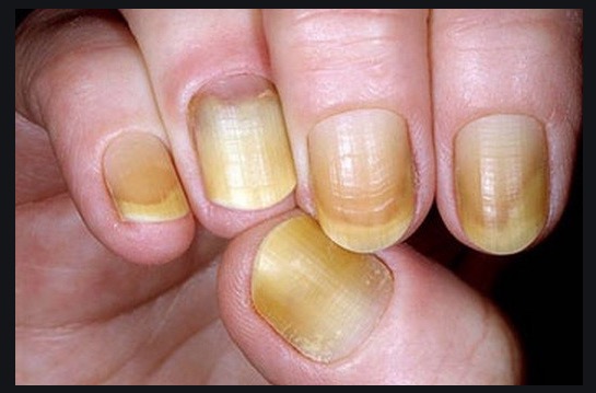 Veja o que fazer para clarear unhas amareladas pelo esmalte