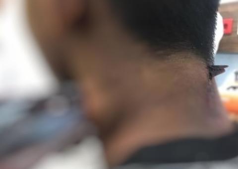 Jovem sobrevive depois de ter peixe-agulha atravessado no pescoço 