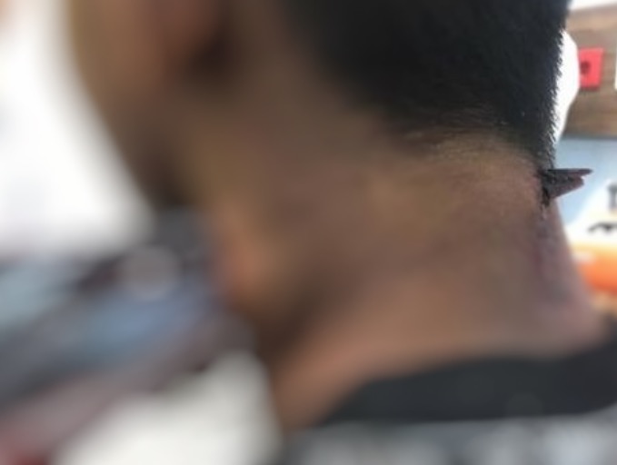 Jovem sobrevive depois de ter peixe-agulha atravessado no pescoço 