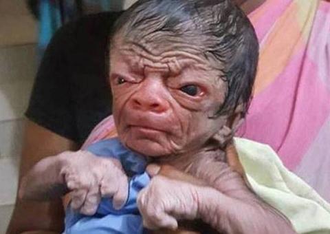 Bebê nasce com aparência de idoso e é comparado a Benjamin Button