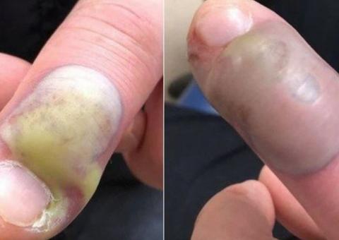 Homem quase morre após contrair infecção por roer unhas