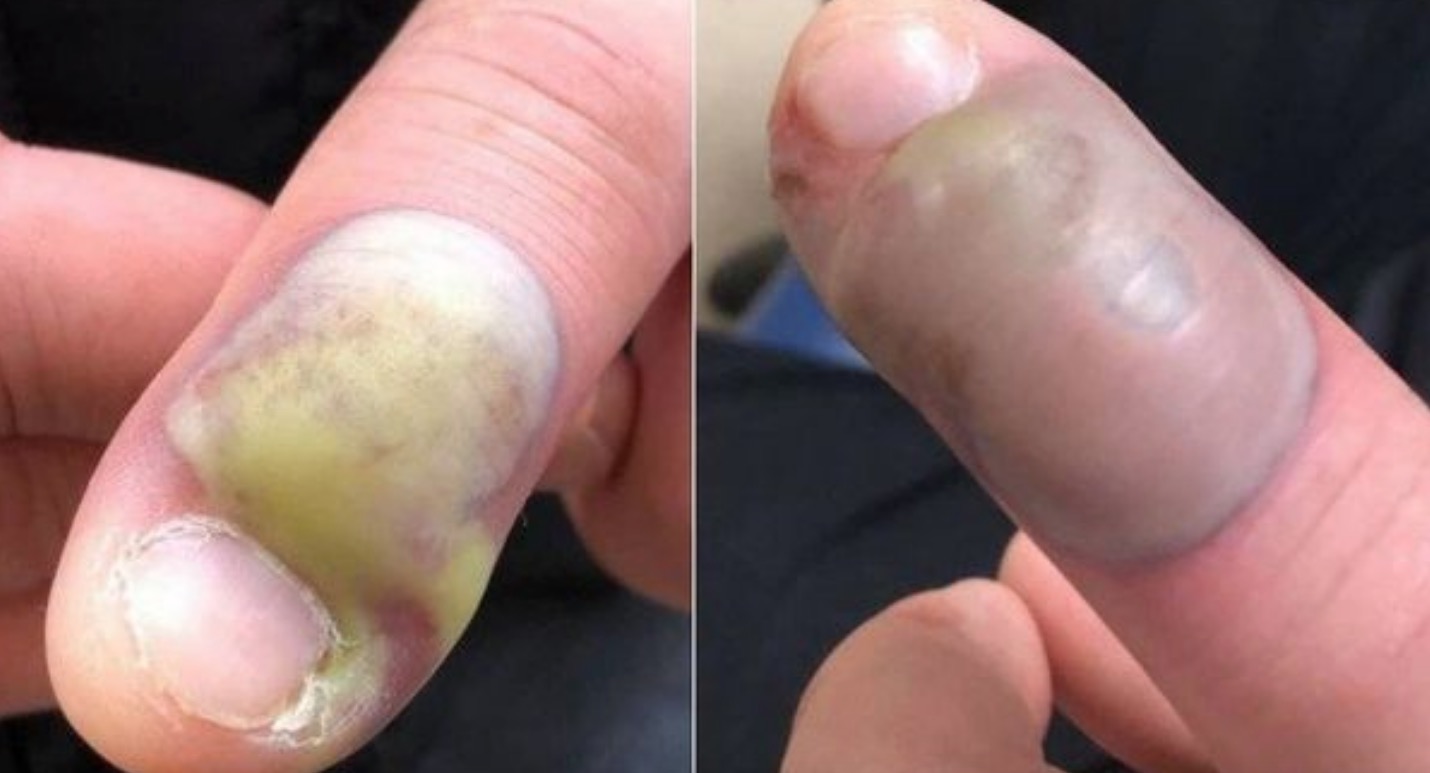 Homem quase morre após contrair infecção por roer unhas