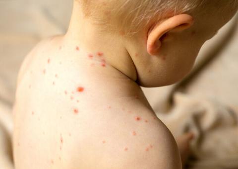 Bebê de 8 meses é primeira vítima de sarampo no Rio em 20 anos