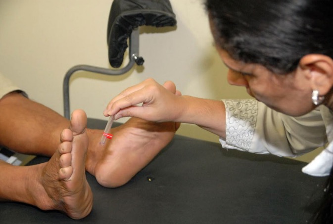 MP lança sistema de atendimento a pacientes com pé-diabético no Amazonas