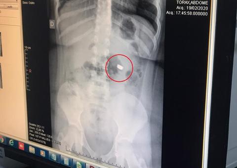 Criança é internada após engolir bateria de lanterna