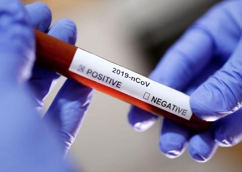 Coronavírus: Sobe para 30 o número de casos confirmados no Brasil