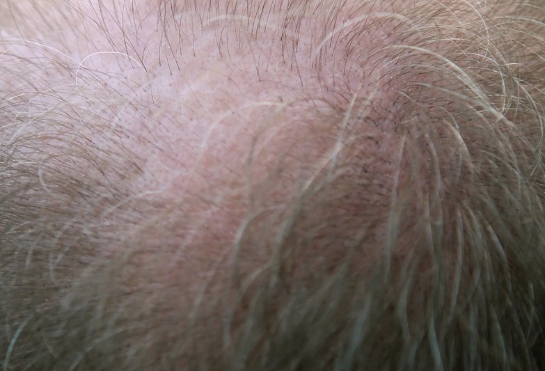 Conheça 5 verdades sobre queda capilar