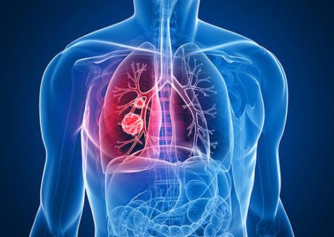 'Tempestade inflamatória' ajuda a explicar mortes pela Covid-19