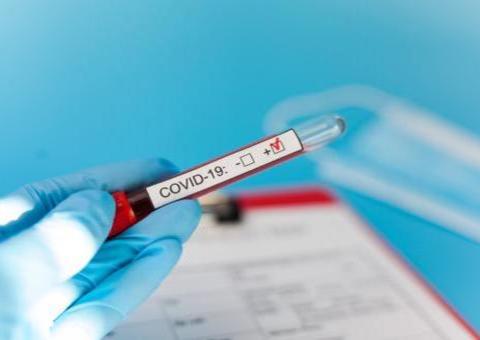 Com 51 novos casos, Amazonas tem 311 infectados por coronavírus 