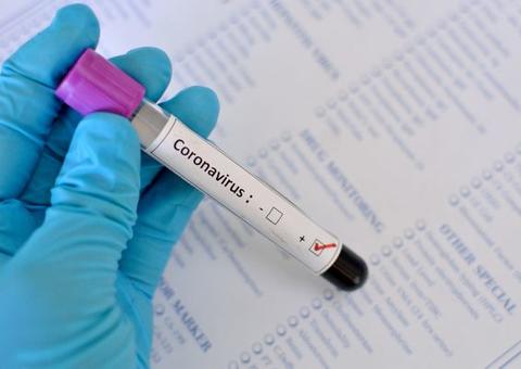 Amazonas possui 700 exames no aguardo de resultado para Covid-19