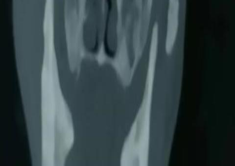 Idoso tem faca enferrujada retirada do crânio após 26 anos