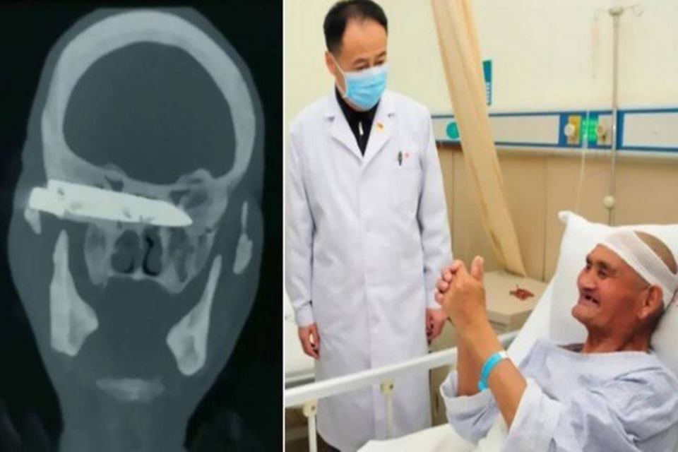 Idoso tem faca enferrujada retirada do crânio após 26 anos
