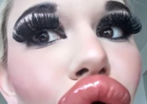 Jovem choca com aparência após fazer 20 procedimentos de preenchimento labial 