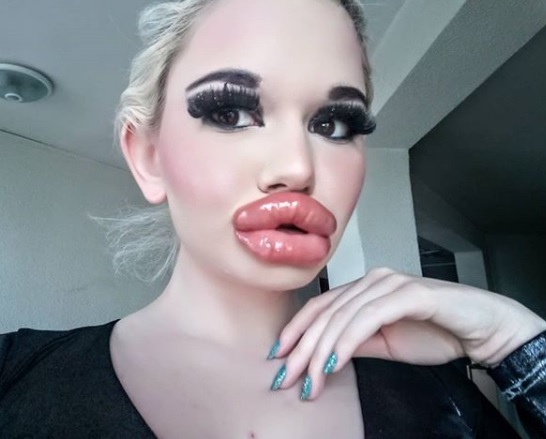 Jovem choca com aparência após fazer 20 procedimentos de preenchimento labial 